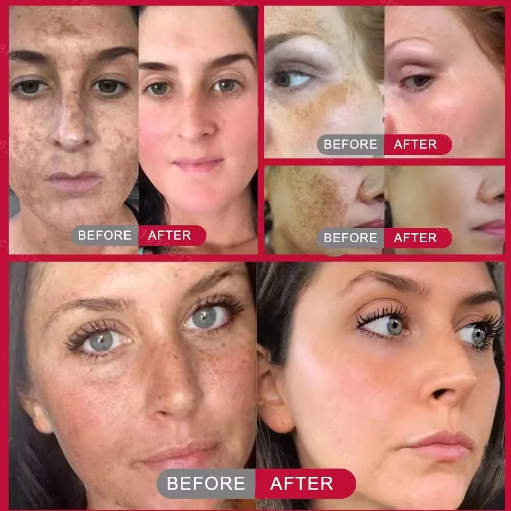 Powerful Dark Spots Remover Whitening Serum Face Freckle Melanin Correcting Anti Pigmentation Brighten Skin Beauty Care Products