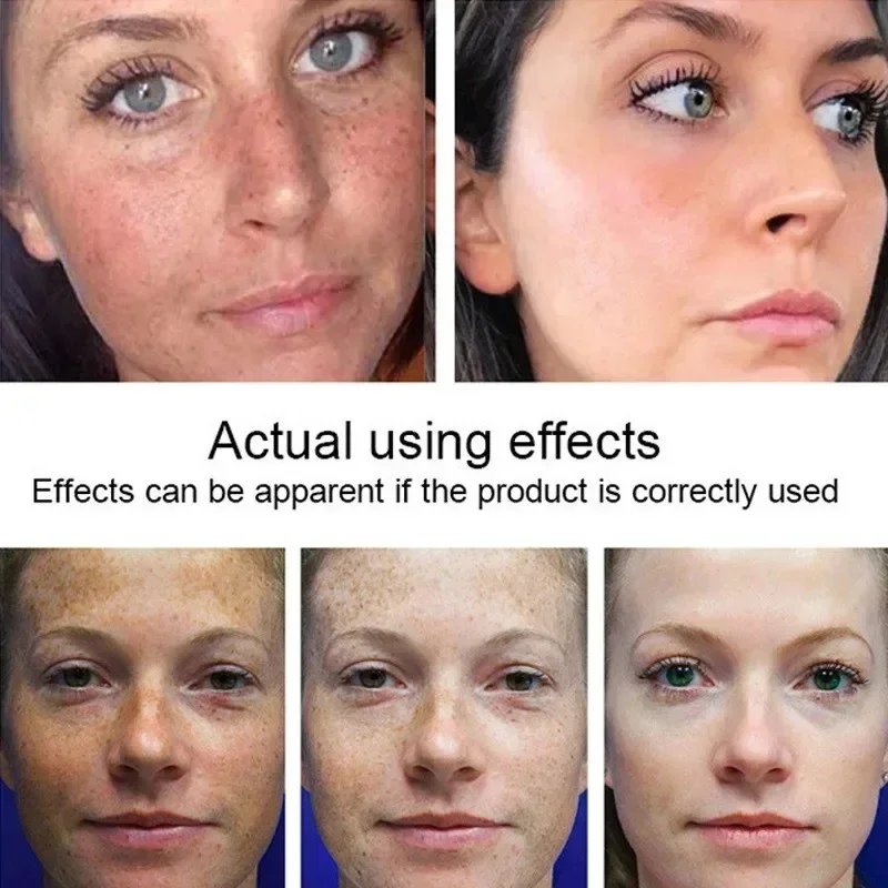 Powerful Dark Spots Remover Whitening Serum Face Freckle Melanin Correcting Anti Pigmentation Brighten Skin Beauty Care Products