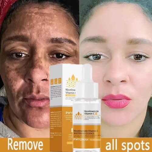 Powerful Dark Spots Remover Whitening Serum Face Freckle Melanin Correcting Anti Pigmentation Brighten Skin Beauty Care Products